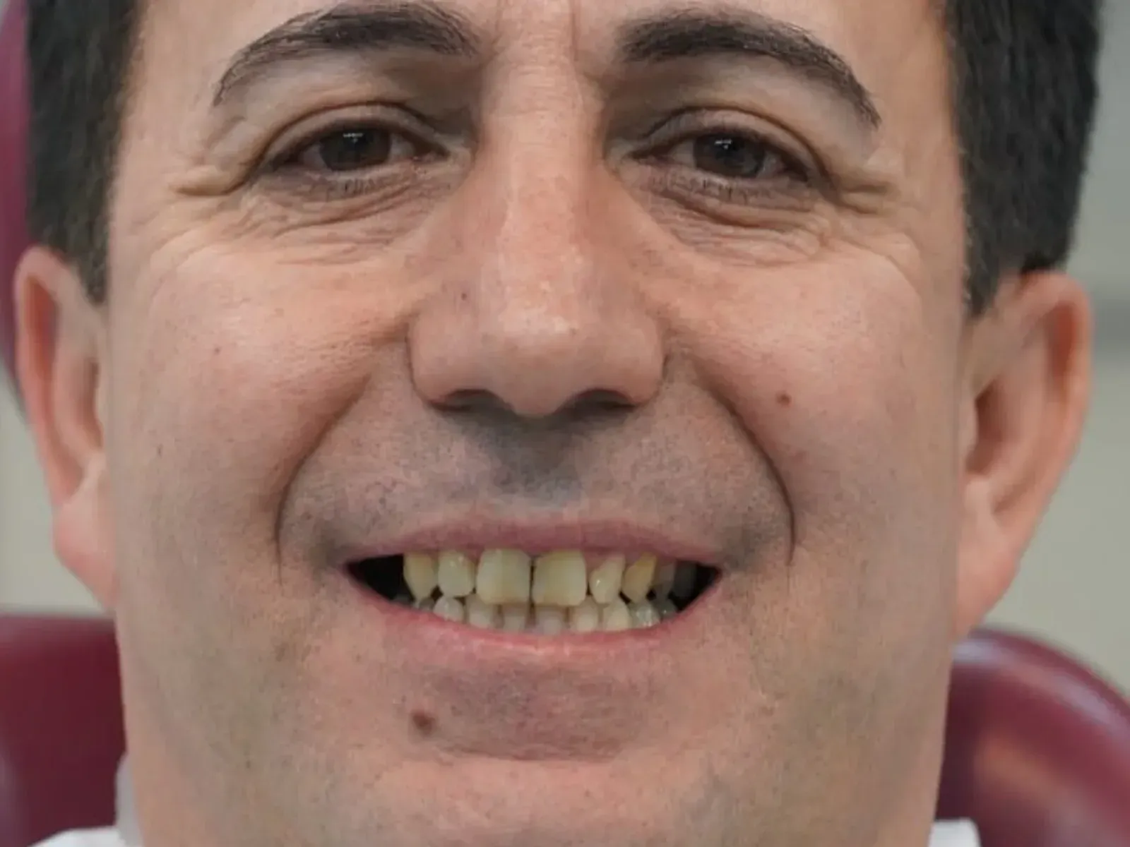 Before dental implants — case from our clinic
