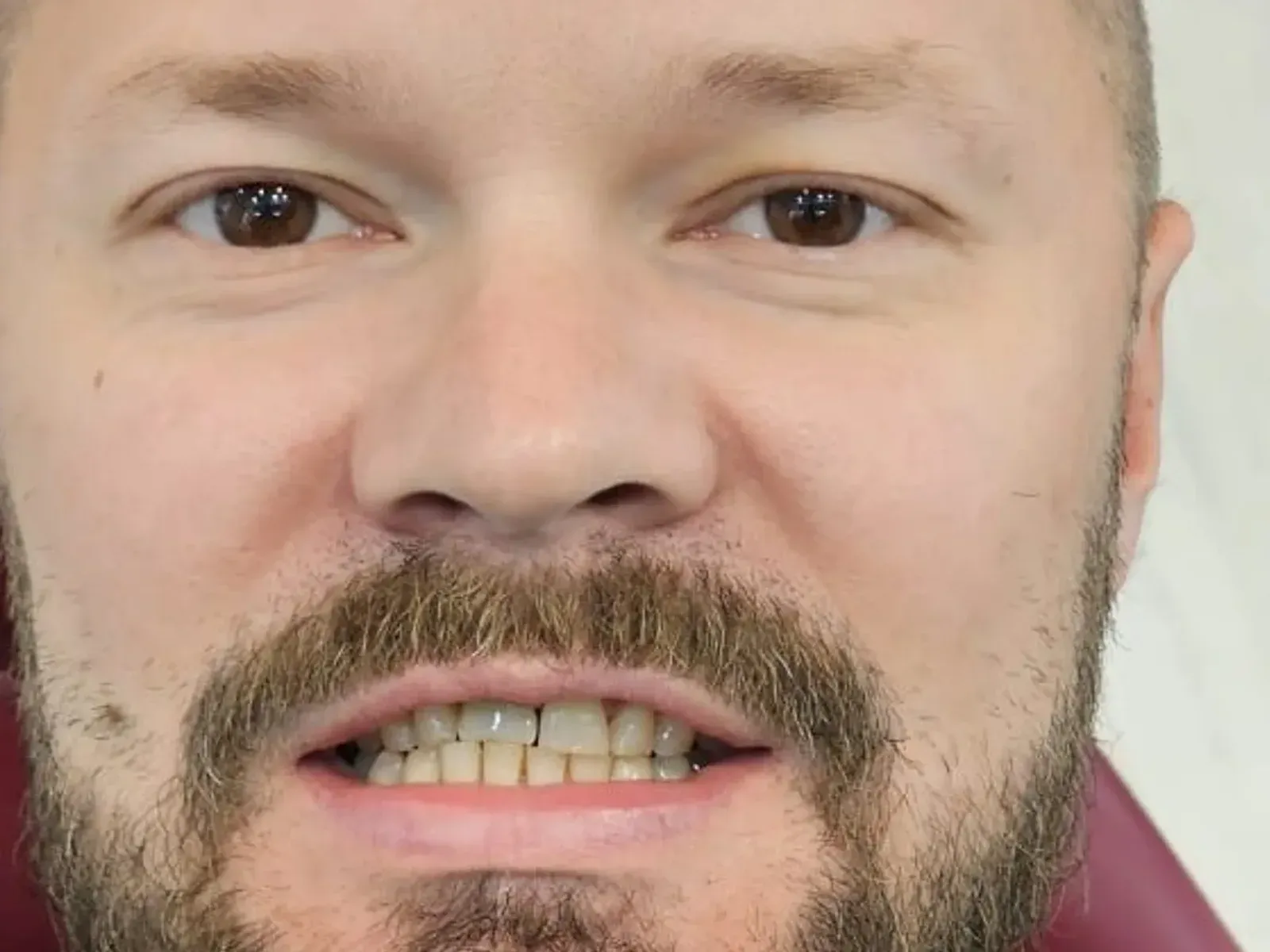 Before dental implants — case from our clinic