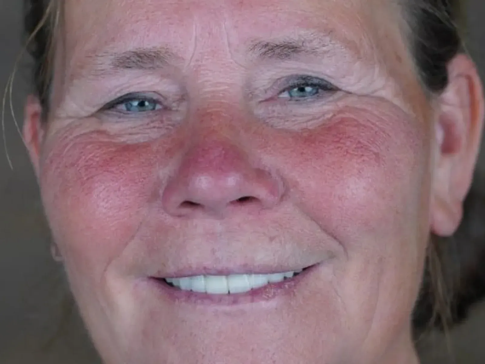 After dental implants — case from our clinic